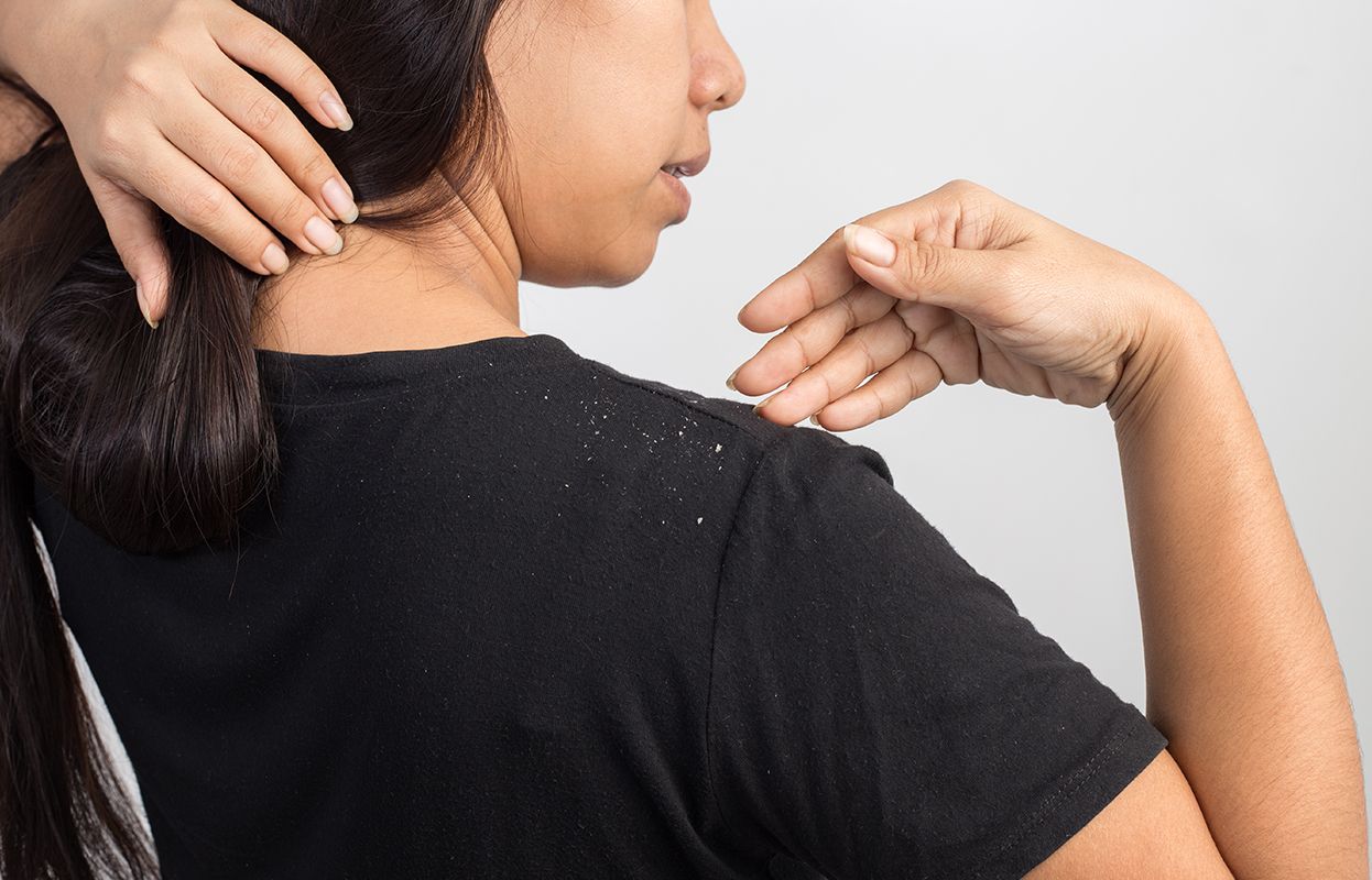 A woman irritated with dandruff all over her hair and shoulders